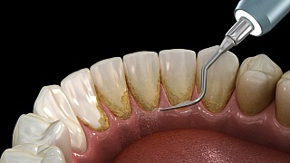 Удаление зубных отложений: все возможные методы