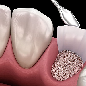 Костная пластика при имплантации