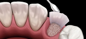 Костная пластика при имплантации