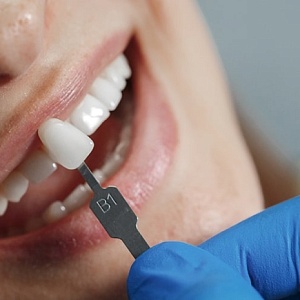 Реставрация зубов: показания, методы, этапы, результаты