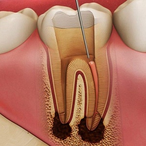 Гной в зубе: причины, осложнения, методы лечения