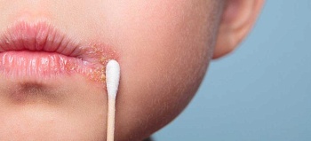 Как лечить заеды в уголках рта: методы и профилактика