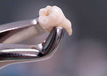 Экстракция зуба: кому показана и как проводится