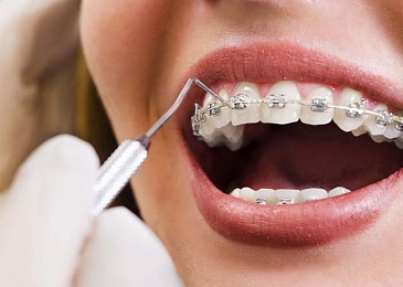 Ортодонтическое лечение: путь к здоровой и красивой улыбке