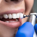 Чистка зубов у стоматолога: показания, этапы и стоимость