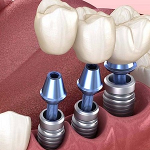 Какое протезирование зубов лучше: сравнение материалов, способов крепления и конструкций