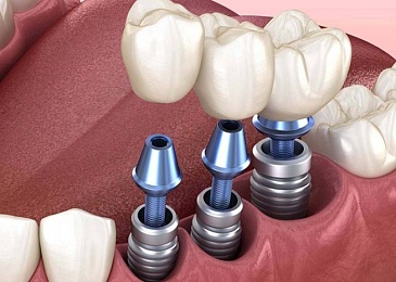 Какое протезирование зубов лучше: сравнение материалов, способов крепления и конструкций