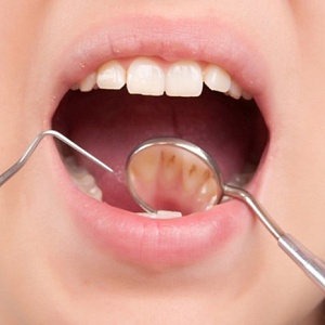 Как удалить зубной камень и почему это нужно делать