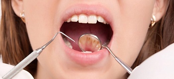 Как удалить зубной камень и почему это нужно делать