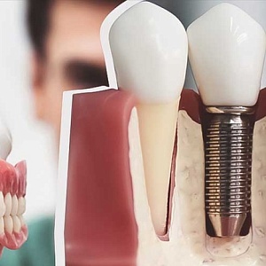 Виды протезирования зубов: конструкции, показания, особенности