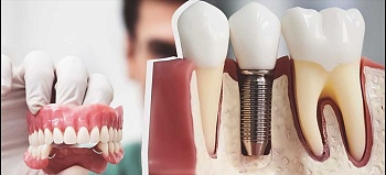 Виды протезирования зубов: конструкции, показания, особенности